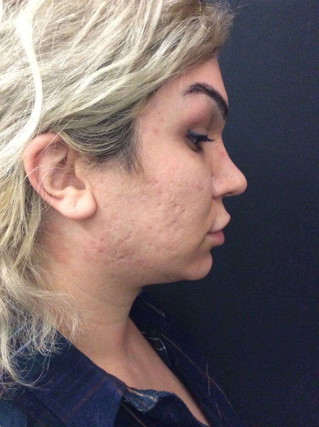 Before a HydraGlass facial: visible acne scarring and uneven skin texture