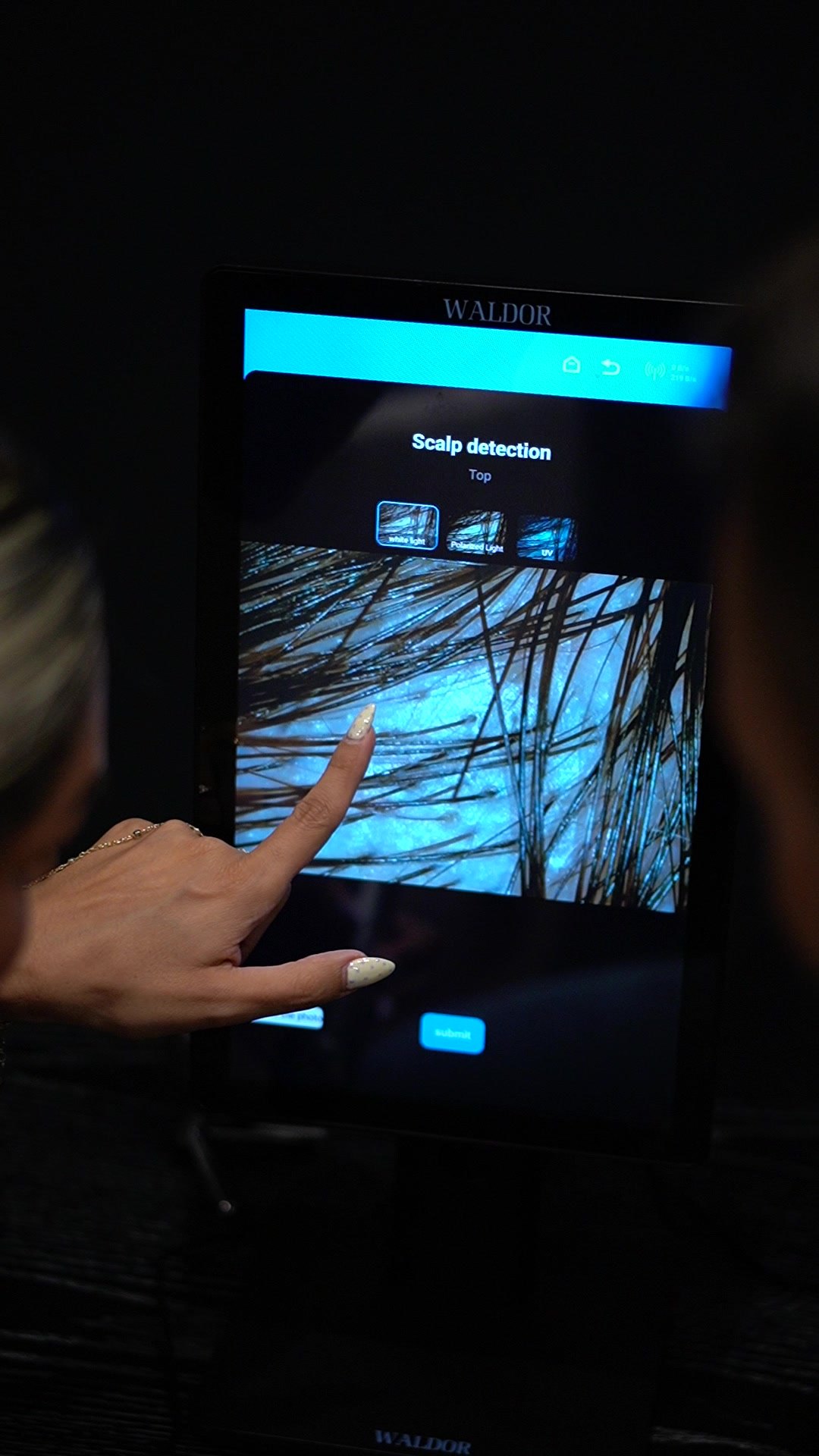 The Waldor Clinic scalp detection screen showing magnified follicle imaging during an AI scalp analysis